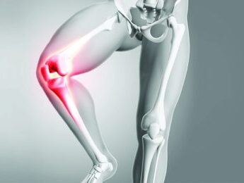 5 Myths and Facts About Knee Replacement Surgery