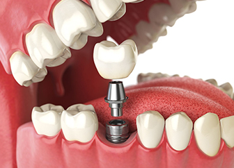 Dental Implants