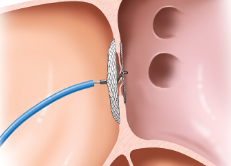 Device Closure of Congenital Defects