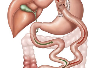 Mini Gastric Bypass