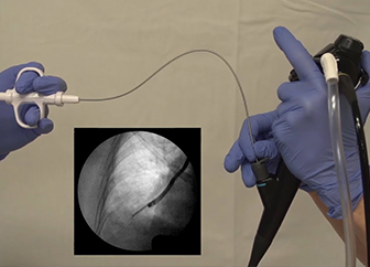 Transbronchial Biopsy