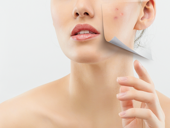 How to Treat PCOS Acne Problems Effectively